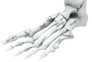 Bone Pins used in orthopedic surgeries for fixation of repairing or damaged bones. It is available in various variations and sizes.