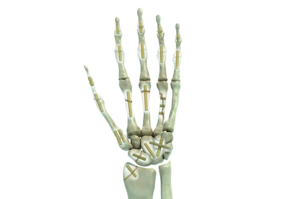 Sharkscrew indication hand